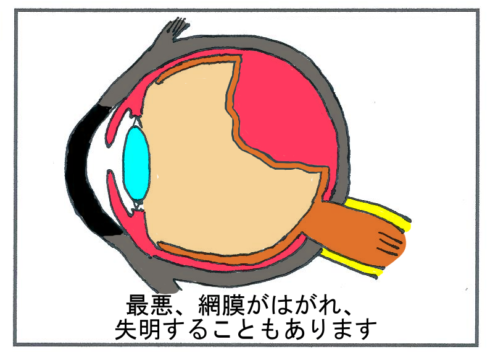 糖尿病の合併症(網膜はく離・失明)