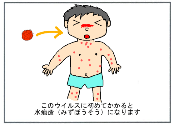 帯状疱疹の原因２