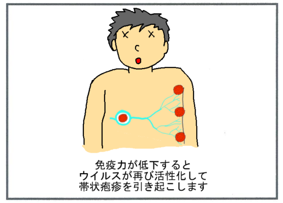 帯状疱疹の原因４