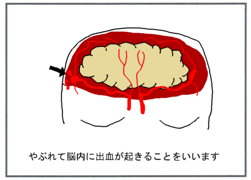 くも膜下出血体験①－４
