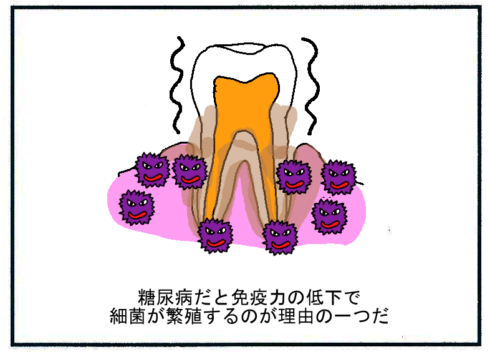 糖尿病の合併症である歯周病３