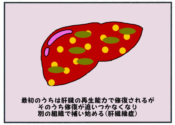 脂肪肝の進行(肝線維症)3