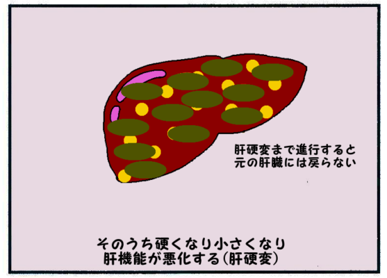 脂肪肝の進行(肝硬変)4