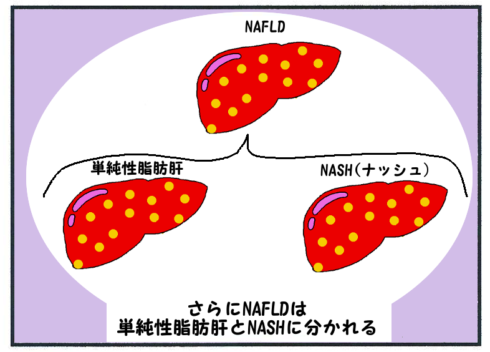 NAFLD(単純性脂肪肝とNASHナッシュ)３